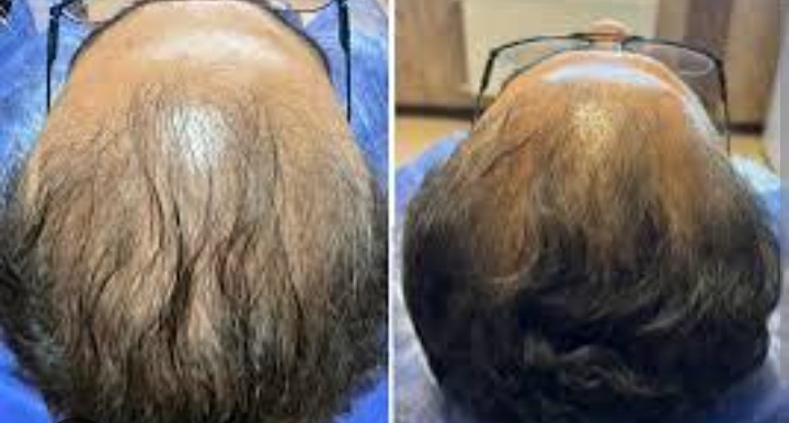 Hair Treatment